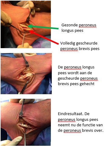 3 foto's peroneus transfer